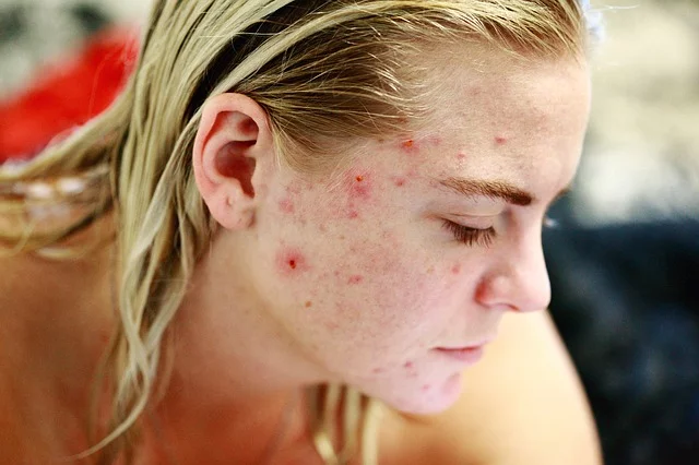 acne treatment in Sydney